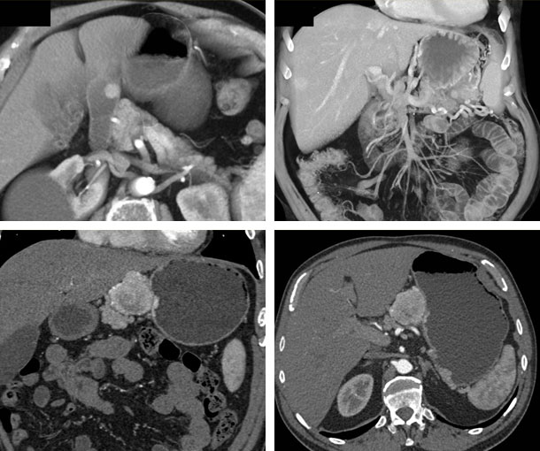 Gastric Carcinoid Tumor CT Findings