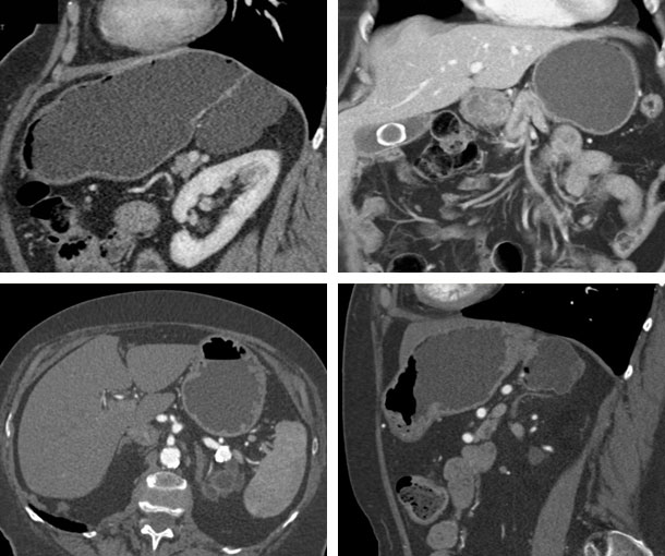 Gastric Diverticulum CT Findings