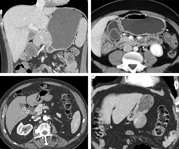 Gastric Duplication Cyst CT Findings