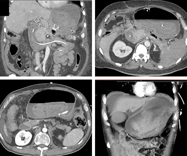 Gastric Hemorrhage CT Findings