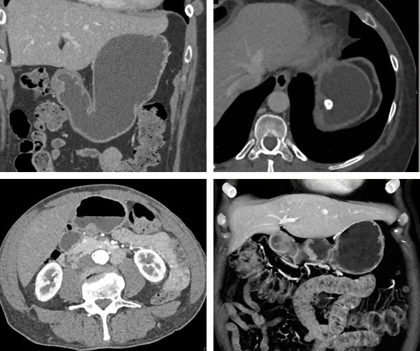 Gastric Leiomyoma CT Findings