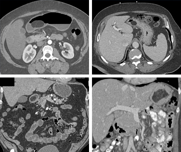 Gastric Lipoma CT Findings