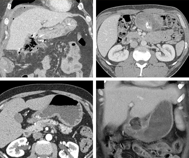 Gastric Ulcer CT Findings