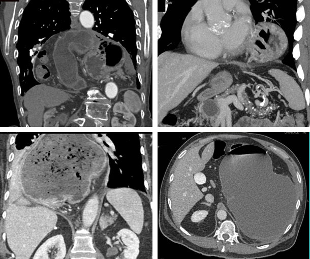 Gastric Volvulus CT Findings