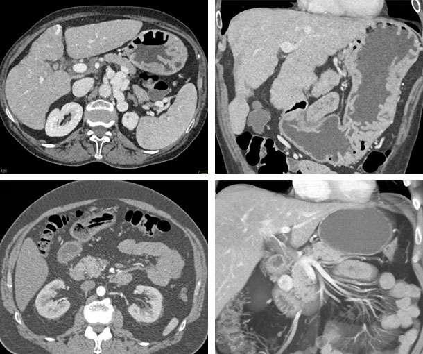 Gastrinoma CT Findings