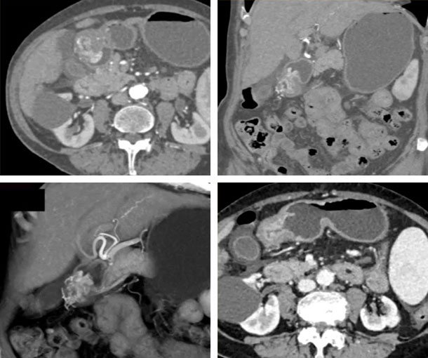 GAVE (Watermelon Stomach) CT Findings