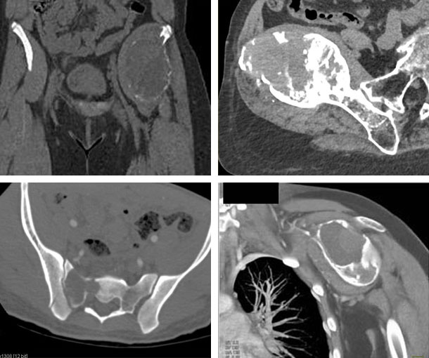 Giant Cell Tumor CT Findings