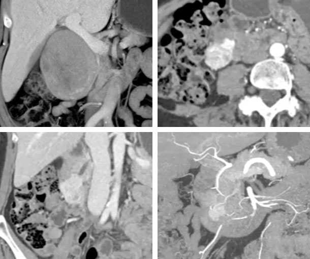 Small Bowel GIST Tumor CT Findings