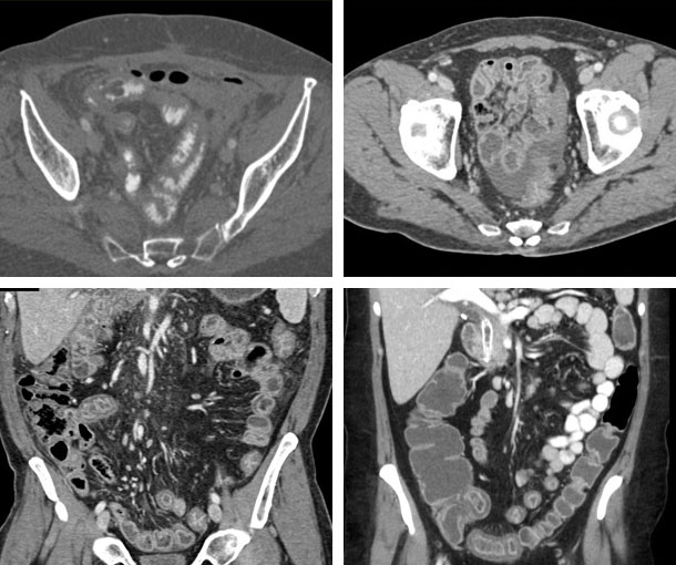 Graft Versus Host Disease CT Findings