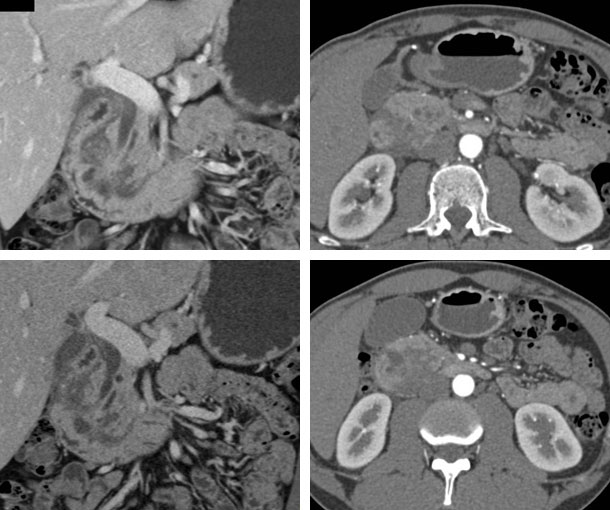 Groove Pancreatitis CT Findings