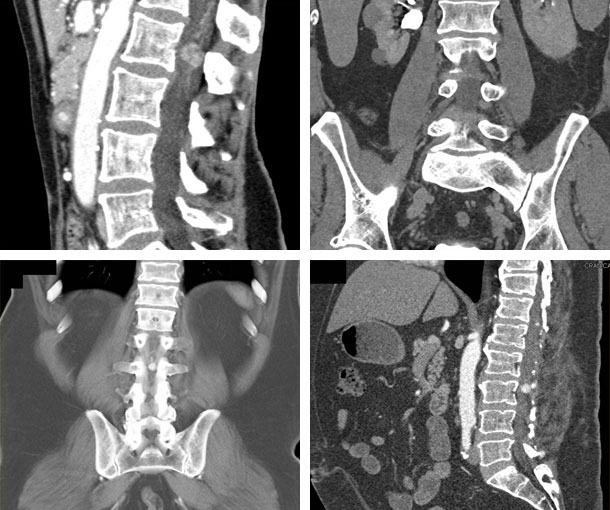 Hemangioblastoma CT Findings