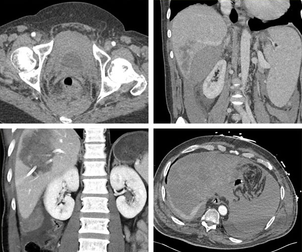 Hemoperitoneum CT Findings