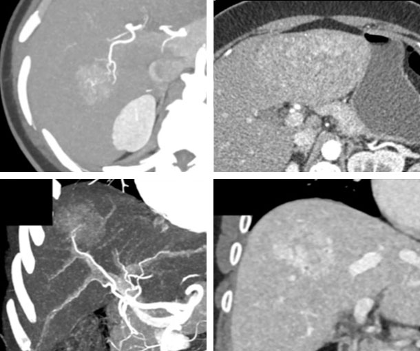 Hepatic Adenoma CT Findings