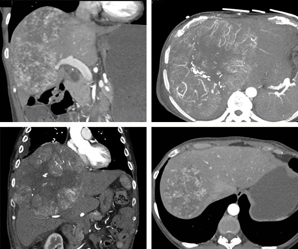 Hepatic Angiosarcoma CT Findings