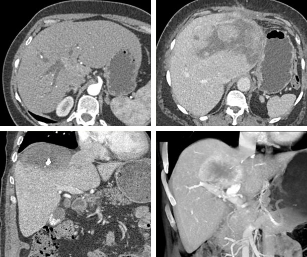 Hepatic Cholangiocarcinoma CT Findings