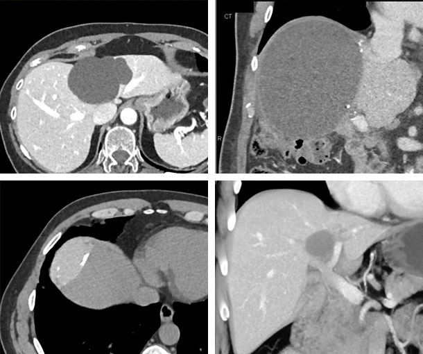 Hepatic Cyst CT Findings