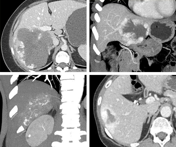 Hepatic Hemangioma CT Findings