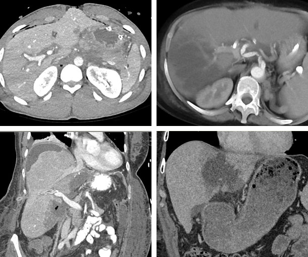 Hepatic Infarction CT Findings