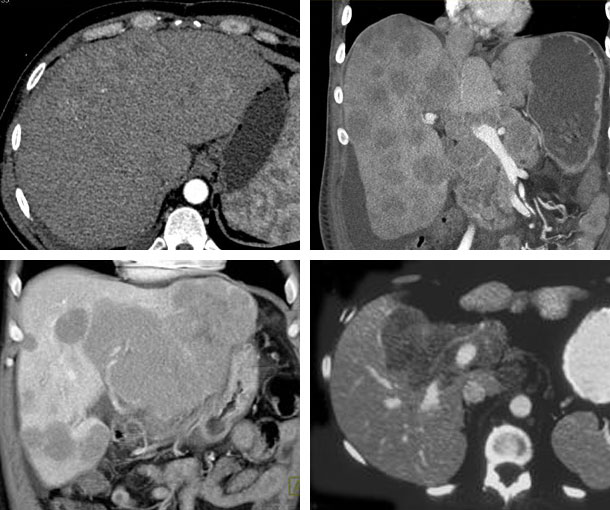 Hepatic Lymphoma CT Findings
