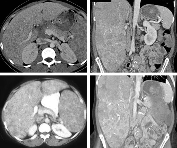 Hepatic Sarcoidosis CT Findings