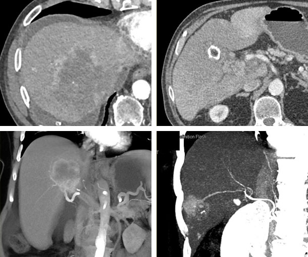 Hepatoma CT Findings