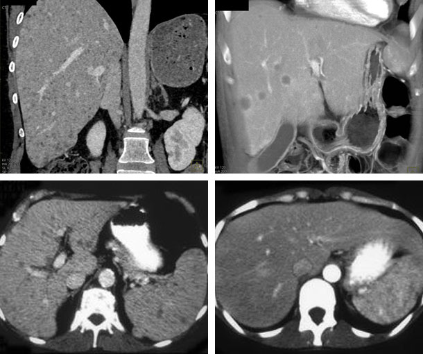 Hepatosplenic Candidiasis CT Findings
