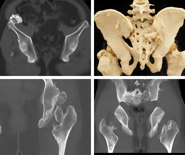 Hereditary Multiple Exotoses