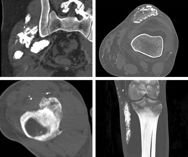 Heterotopic Ossification