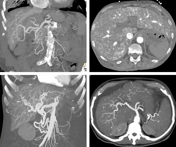 HHT CT Findings