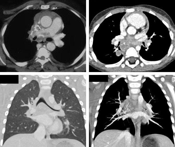 Histoplasmosis CT Findings