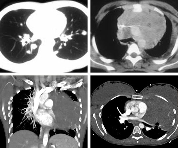 Hodgkin Lymphoma CT Findings