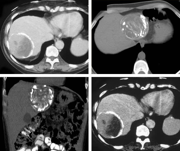 Hydatid Disease CT Findings