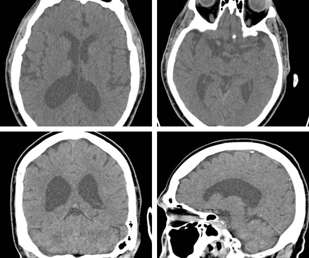 Hydrocephalus CT Findings