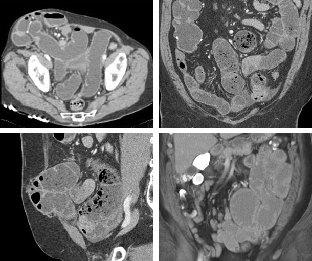 Incisional Hernia CT Findings