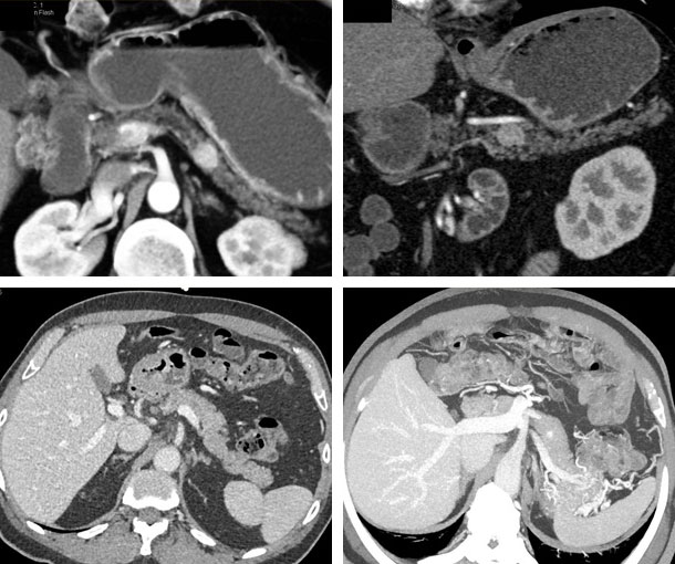 Insulinoma CT Findings