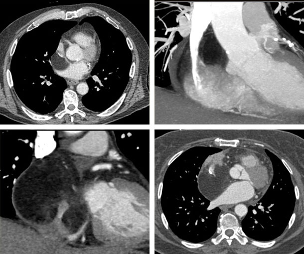 Intrapericardial Lipoma CT Findings
