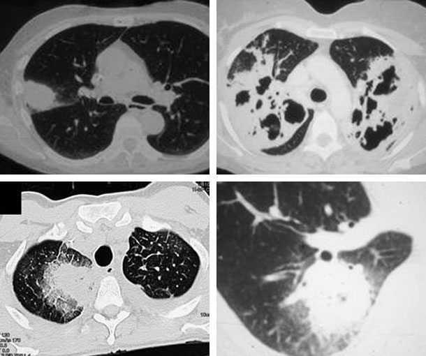 Invasive Aspergillosis CT Findings