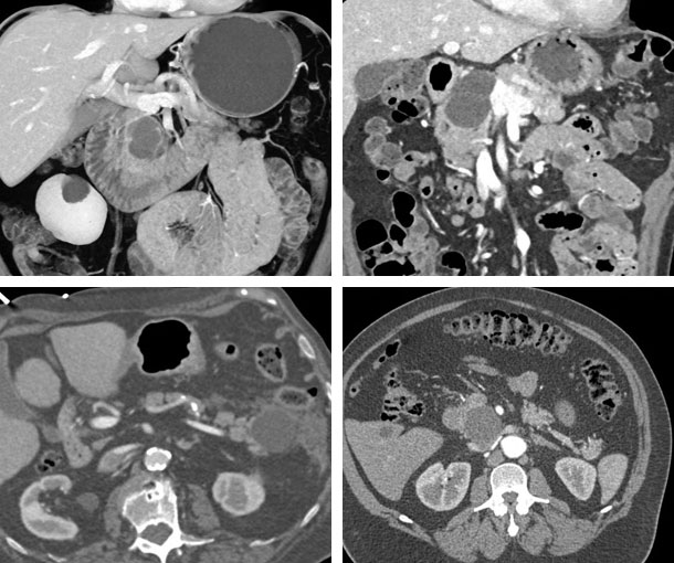 IPMN CT Findings