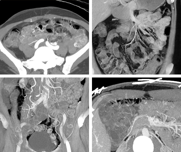 Ischemic Colitis