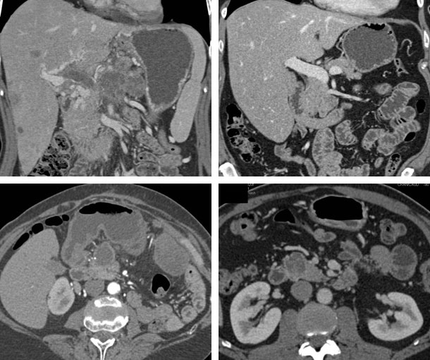 Islet Cell Tumor CT Findings