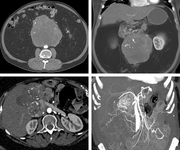 IVC Leiomyosarcoma CT Findings