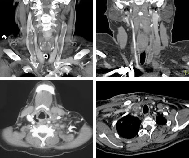 Jugular Vein Thrombosis (JVT) CT Findings