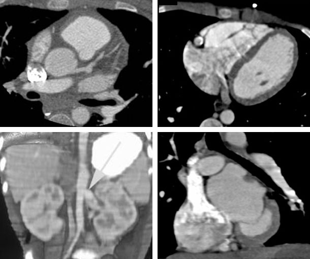Kawasaki Disease CT Findings