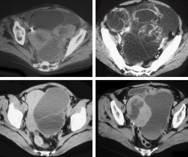 Krukenberg Tumor CT Findings