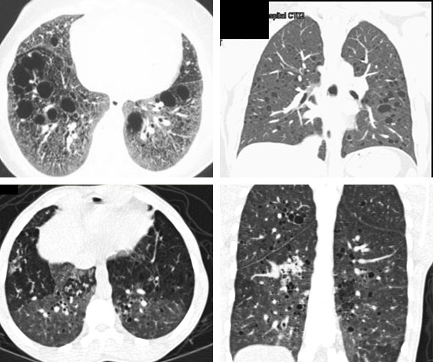 LAM CT Findings