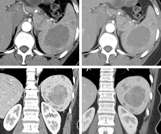 Littoral Cell Angioma CT Findings