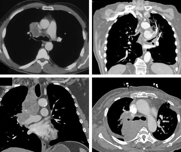 Lung Cancer CT Findings