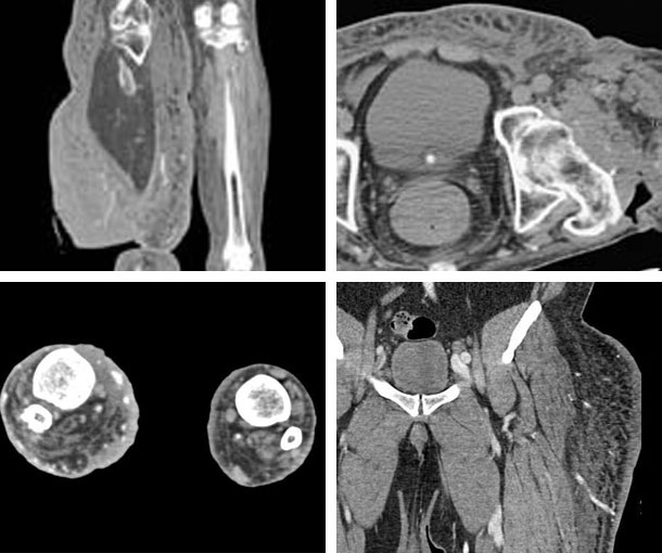Lymphedema CT Findings