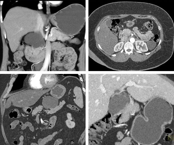 Lymphoepithelial Cyst CT Findings