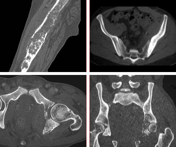 Lymphoma of Bone CT Findings